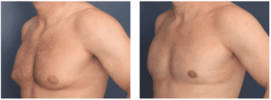 Two images of a male’s chest comparing before and after gynecomastia surgery